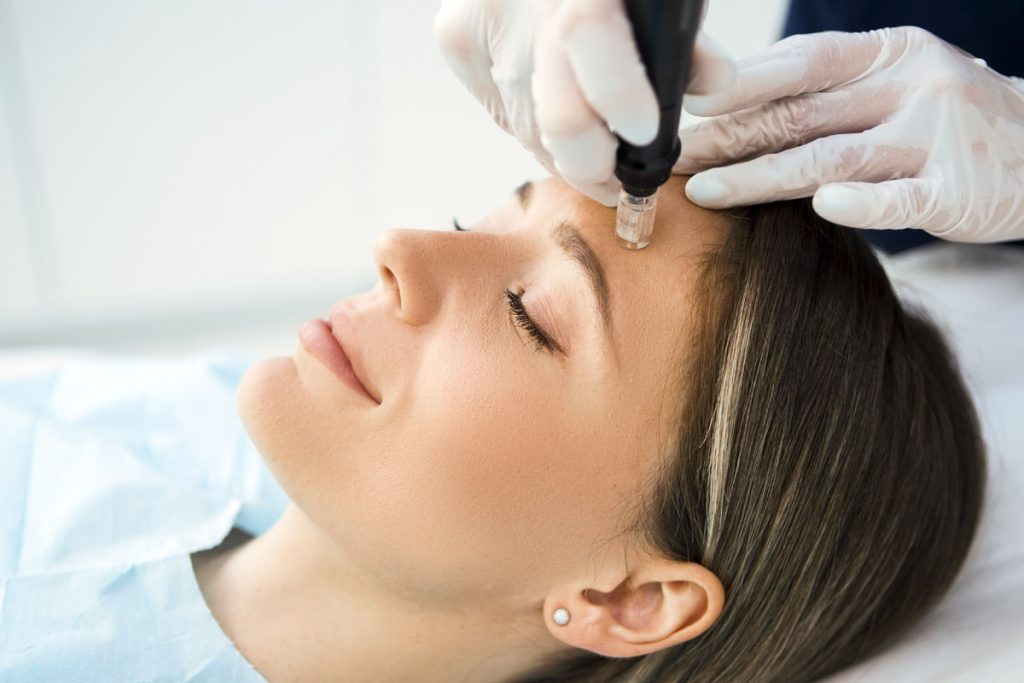 Microneedling treatment